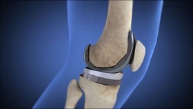 骨性關節炎 手可以感覺到磨擦感 聽到再晚需要關節置換 嚇懵