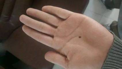 有“痣”者，須注意！磨擦可能帶來的健康風(fēng)險